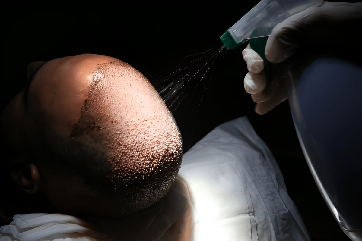 The Benefits of FUE Hair Transplants in London