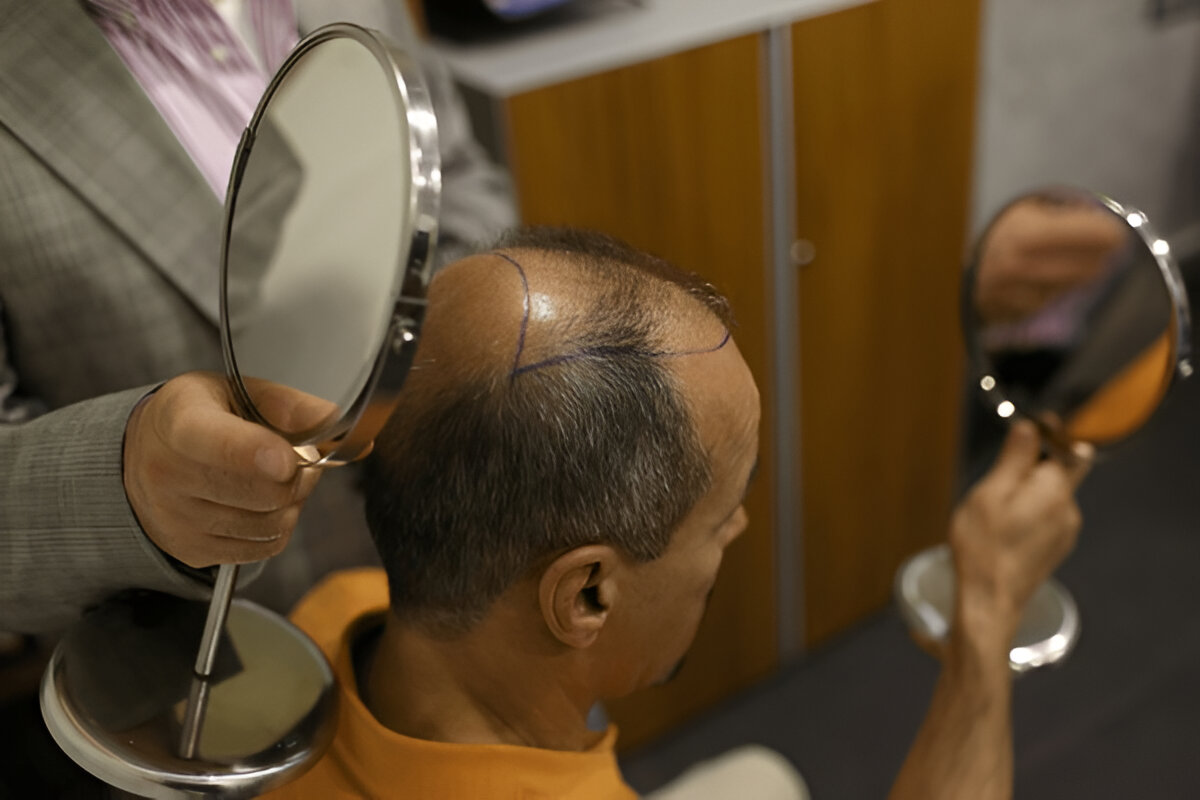 How to Prepare Financially for Your Hair Transplant in the UK