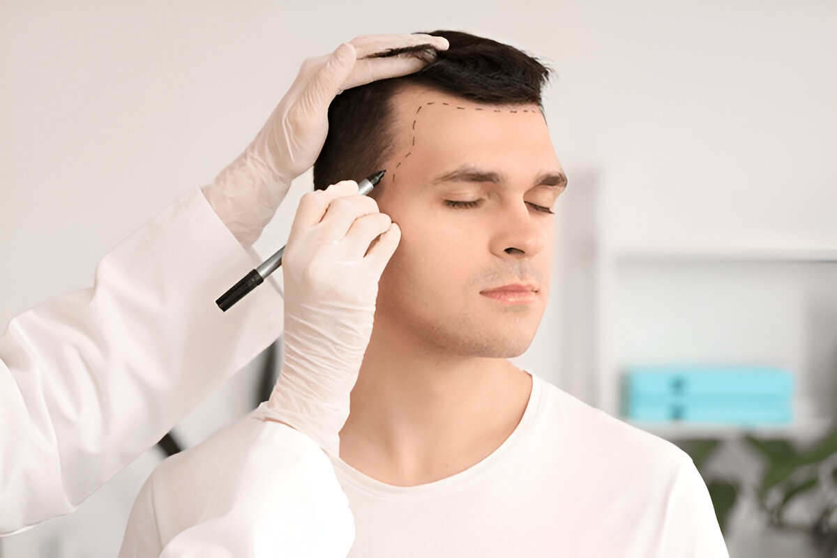 Hair Transplants