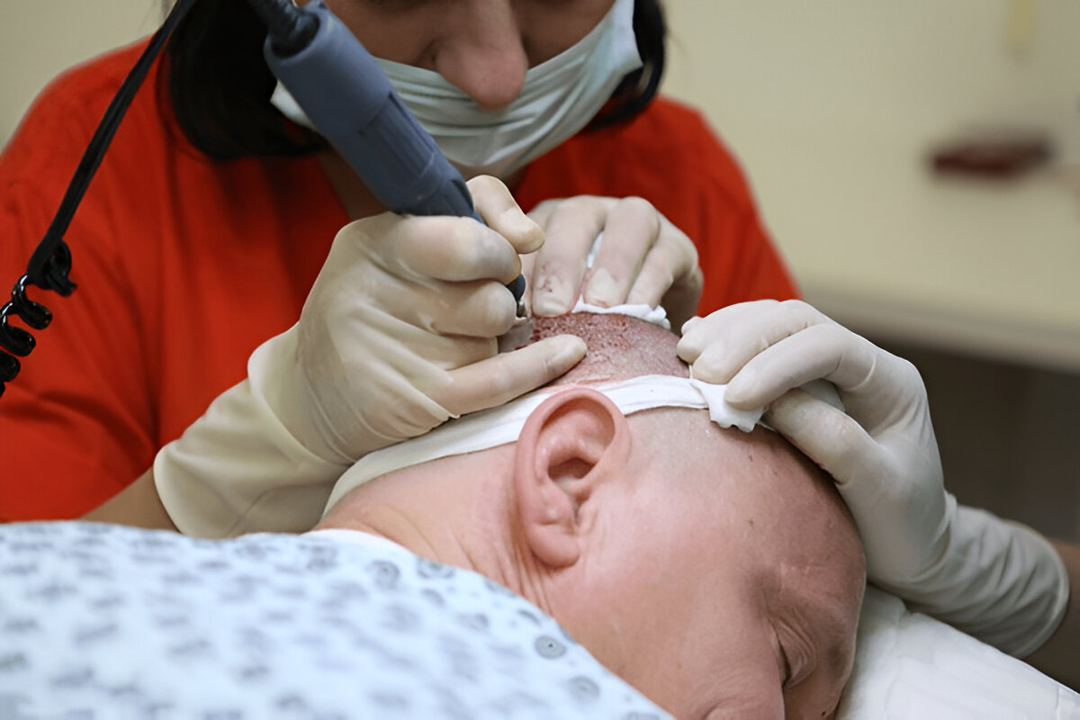 Why Hair Transplants in London Are Gaining Popularity