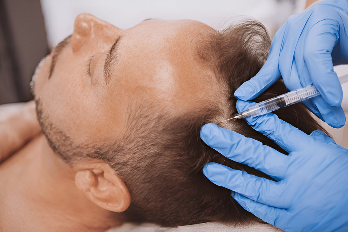 The Secrets to a Successful Hair Transplant Recovery