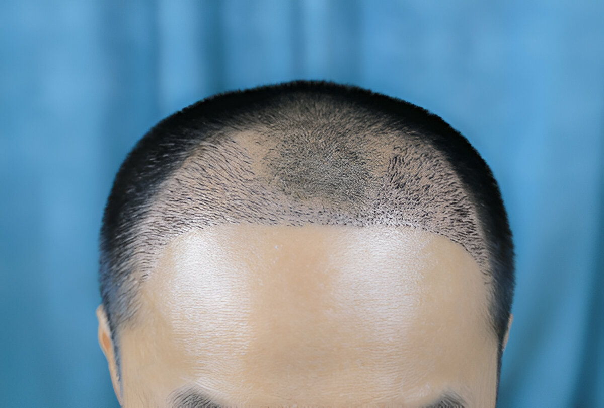 Expectation vs Reality: UK Hair Transplant Journeys
