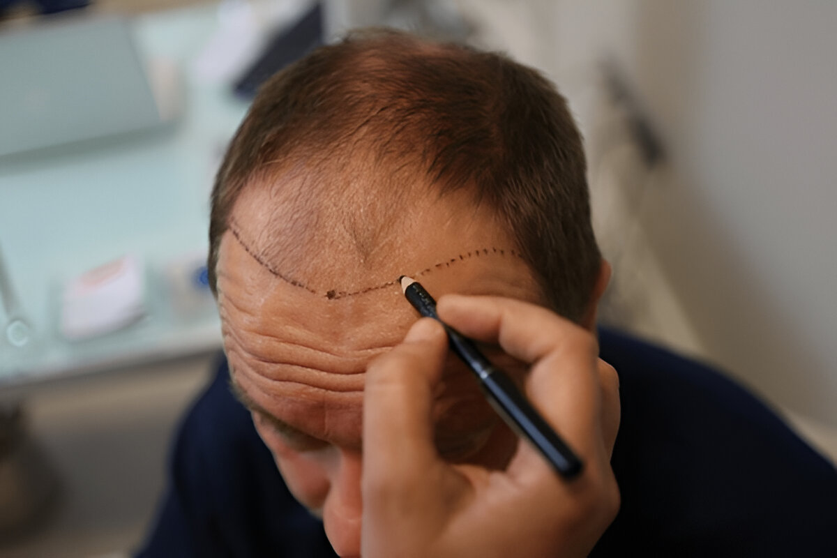 hair transplant UK