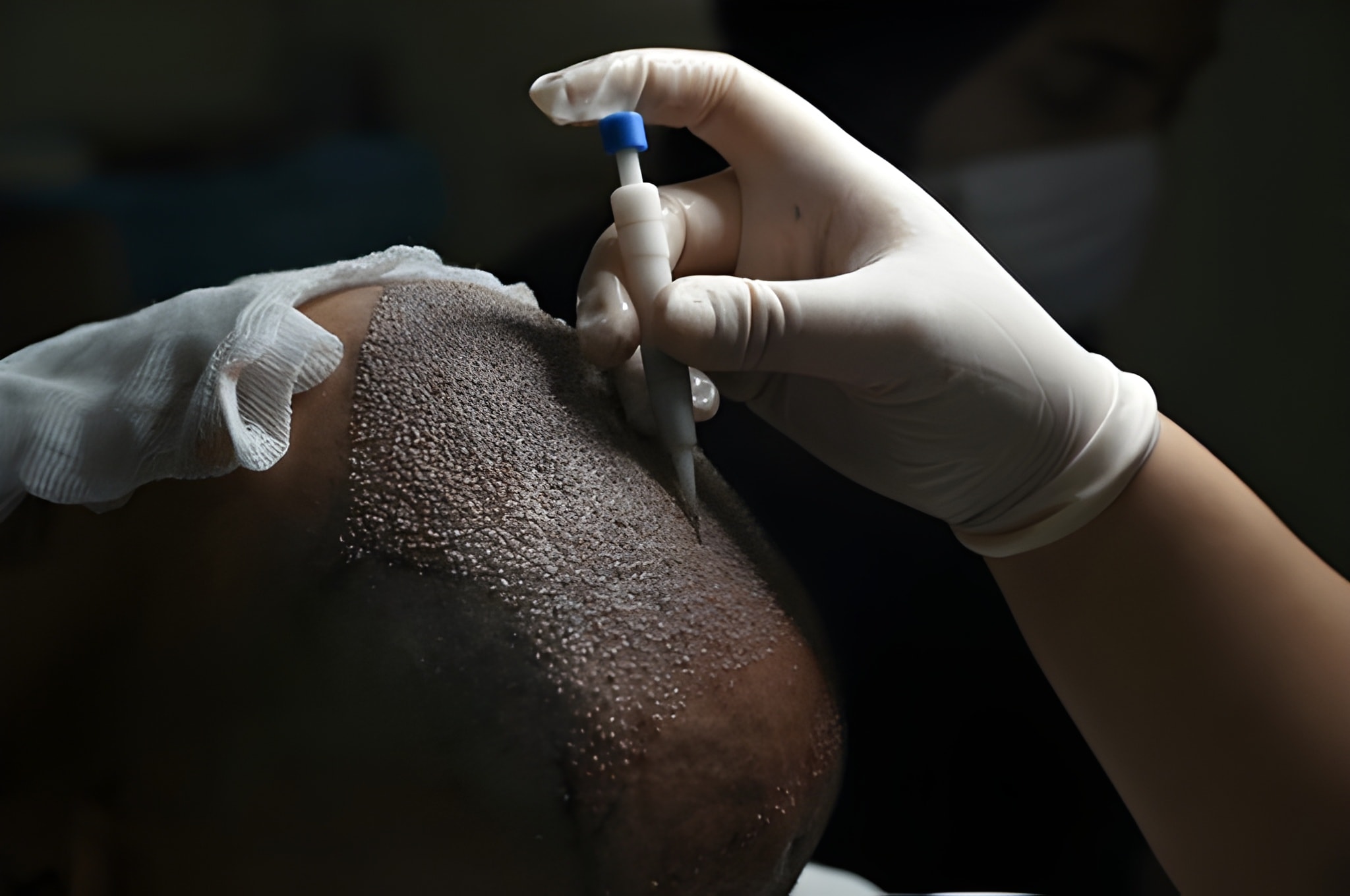 Hair Transplant